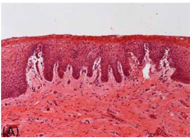 모나리자터치 시술전후
