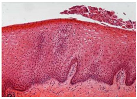 모나리자터치 시술 한달 후 질 점막