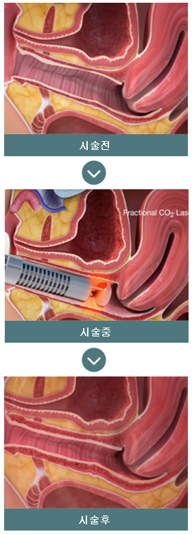 모나리자터치 시술과정
